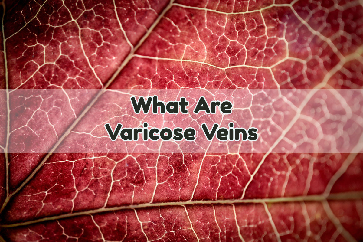 What-Are-Varicose-Veins